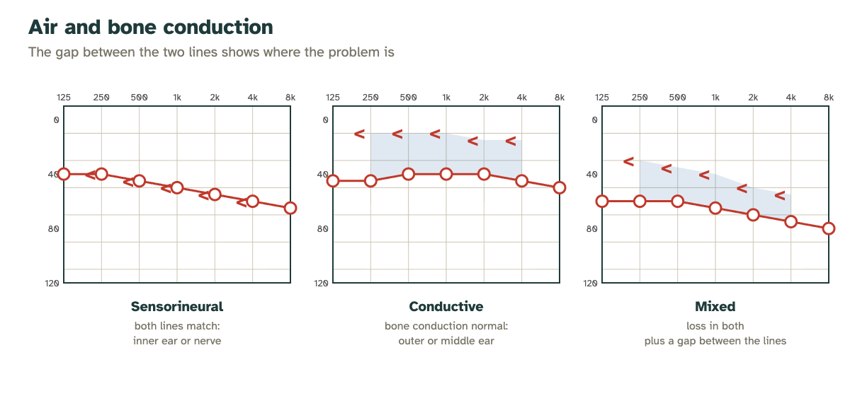Comparison of sensorineural, conductive and mixed hearing loss: position of bone conduction relative to air conduction
