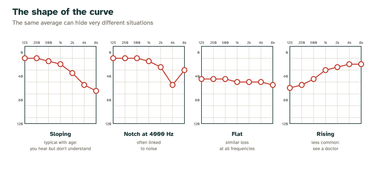 Four typical audiogram shapes: sloping, notch at 4000 Hz, flat and rising