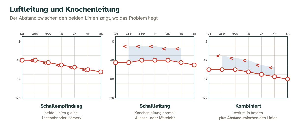 Vergleich von Schallempfindungs-, Schallleitungs- und kombinierter Schwerhörigkeit: Lage der Knochenleitung zur Luftleitung