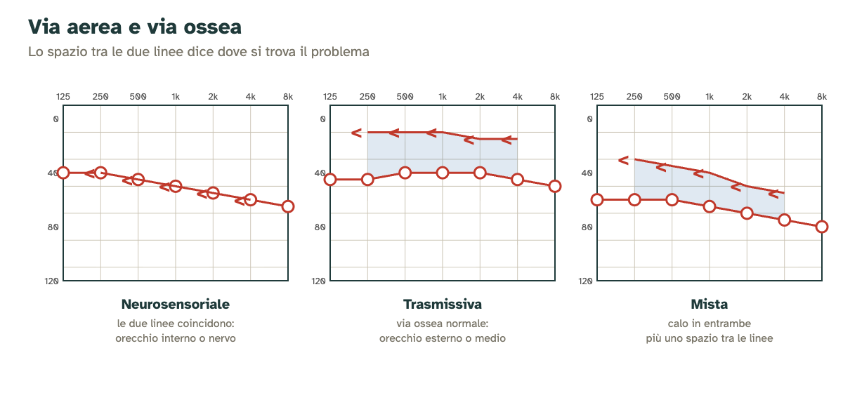 Confronto tra perdita neurosensoriale, trasmissiva e mista: posizione della via ossea rispetto alla via aerea