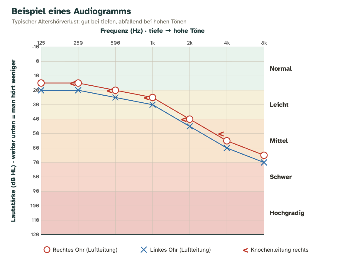 Beispiel eines Audiogramms: Frequenzen von 125 bis 8000 Hz waagrecht, Dezibel senkrecht; die Kurven des rechten (rote Kreise) und linken Ohrs (blaue Kreuze) fallen zu den hohen Tönen ab