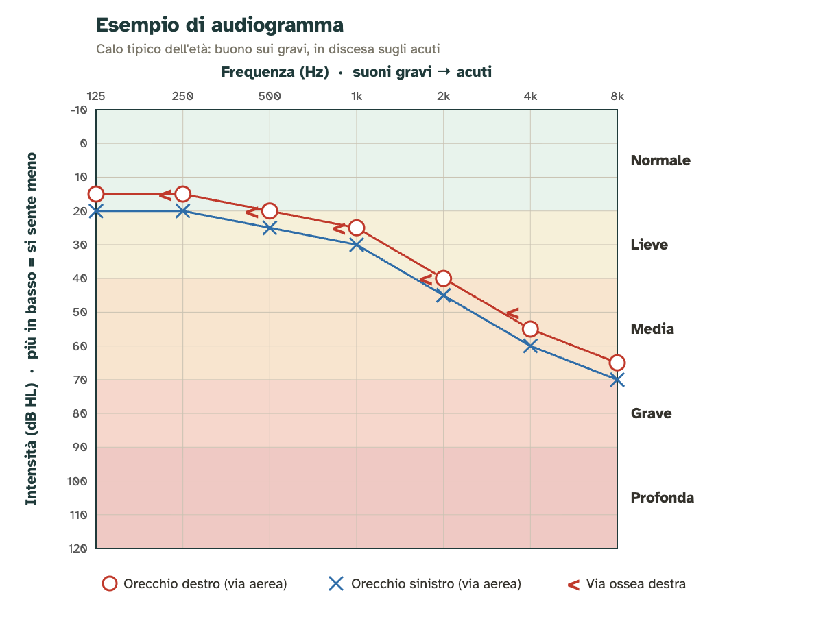 Esempio di audiogramma: frequenze da 125 a 8000 Hz in orizzontale, decibel in verticale; le curve dell'orecchio destro (cerchi rossi) e sinistro (croci blu) scendono sugli acuti, con fasce colorate da normale a profonda