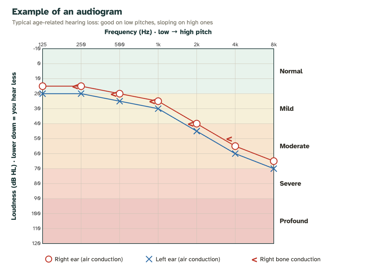 Example of an audiogram: frequencies from 125 to 8000 Hz horizontally, decibels vertically; the curves of the right ear (red circles) and left ear (blue crosses) slope down on the high pitches